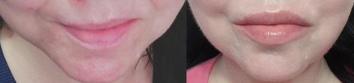 Já rty před výplněmi 52 a 57 let NALEŽATO..jpg