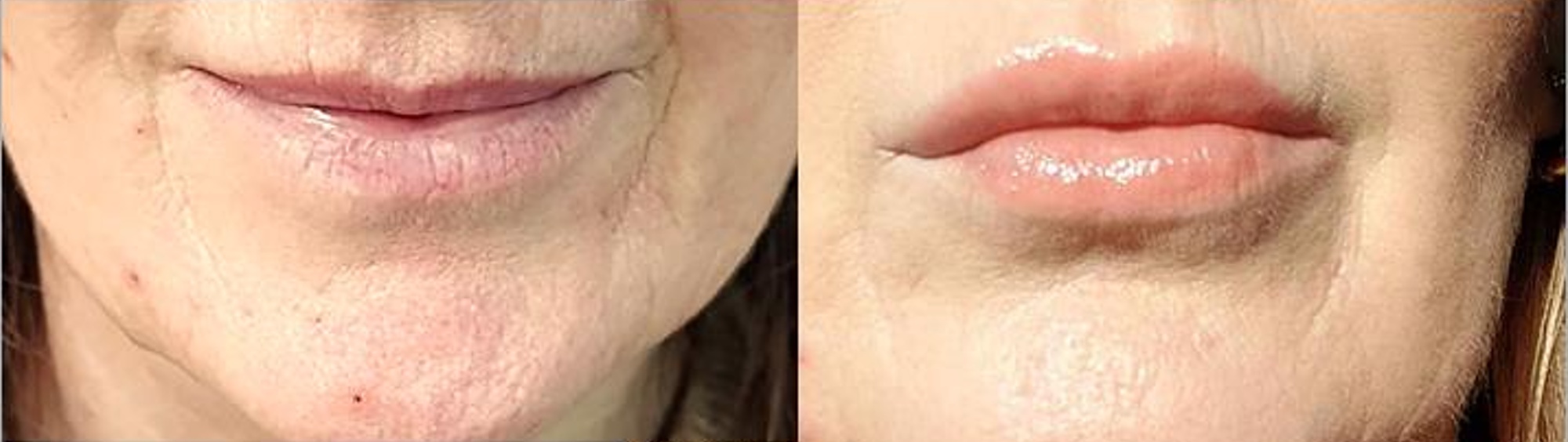 Katka Coufalová po 2x Thermage 1x výpln.jpg