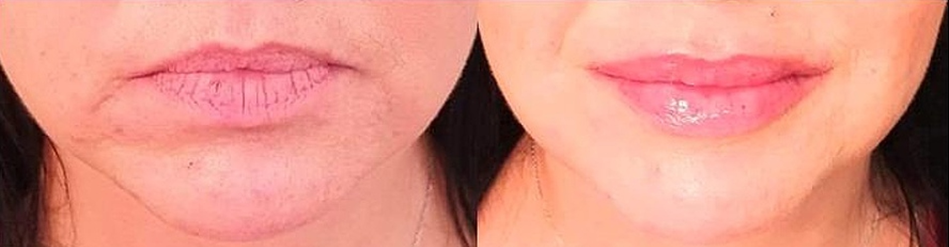 PŘED A PO LIFTINGI HIFU POBRADKU A PO VÝPLNÍCH RTŮ OŘEZ.jpg